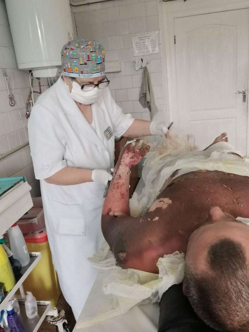 З опіками 90% поверхні тіла пройшов 15 км пішки: у Дніпрі врятували дуже «важкого» бійця