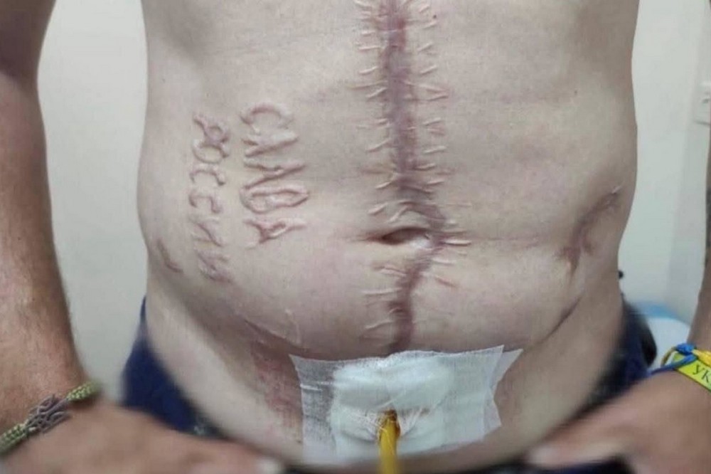 Фото з написом «Слава Росії» на тілі звільненого військового з полону є справжнім