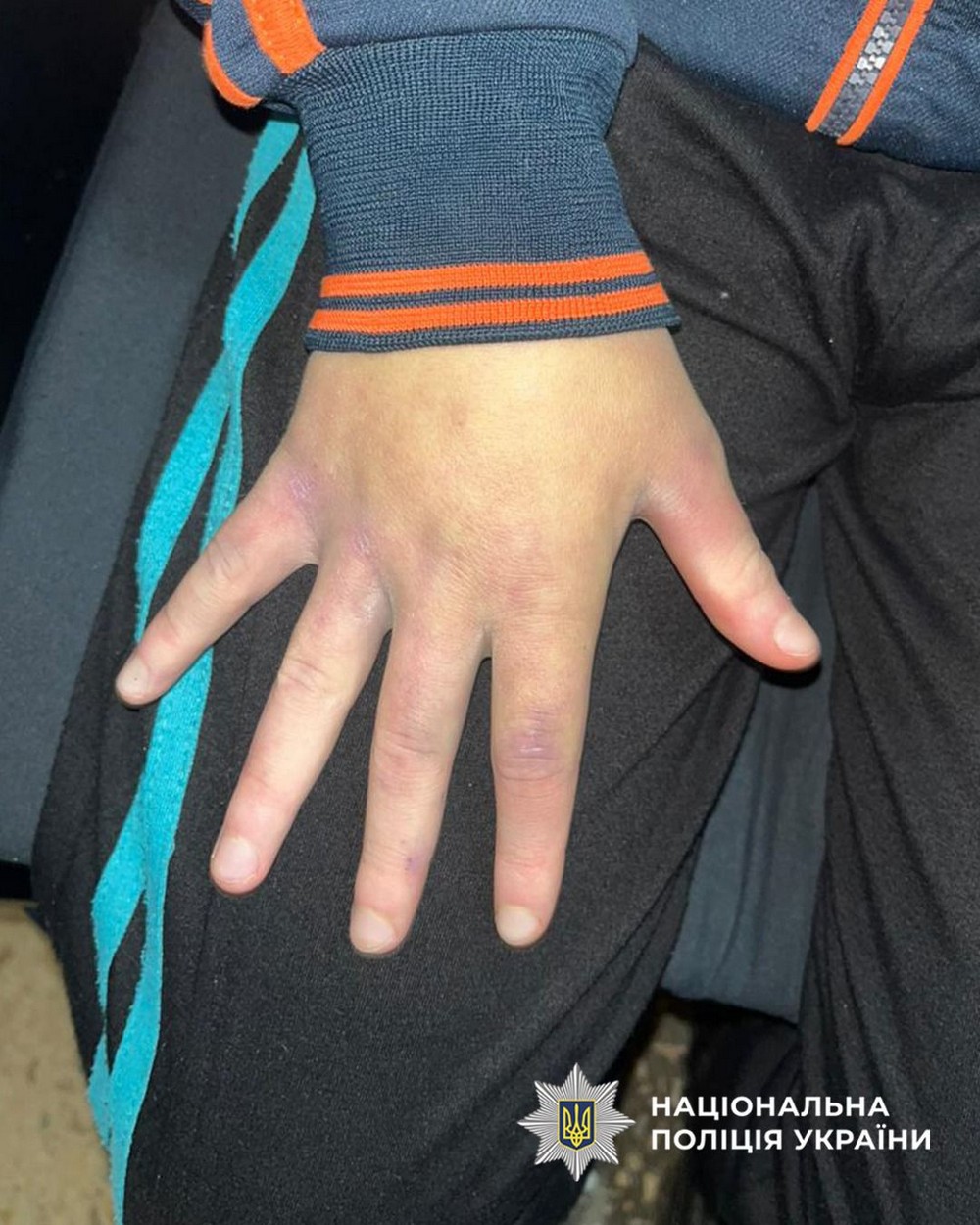 На Черкащині з родини вилучили 13-річного хлопчика. Попередньо встановлено, що дитину побили батьки. Медики надали хлопчику необхідну допомогу. Розслідування триває.