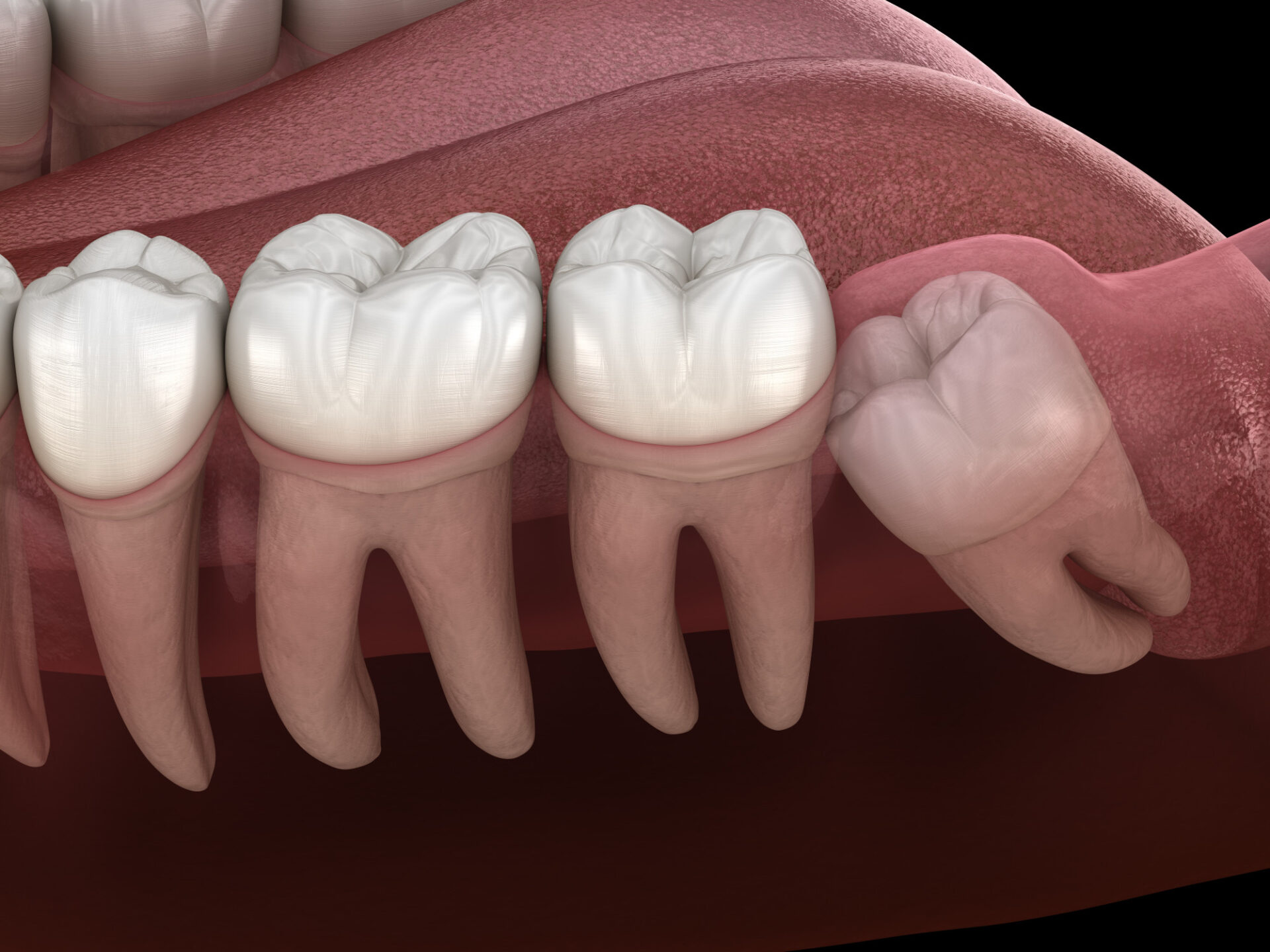wisdom teeth removed