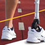 Кожна людина з ампутацією кінцівки має право самостійно обирати підприємство для протезування: куди звертатися