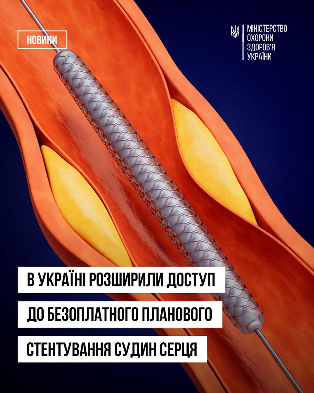 Планове стентування судин серця в Україні тепер безоплатне: як отримати послугу
